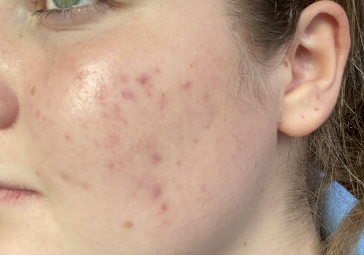 Nach 3 Monaten Image